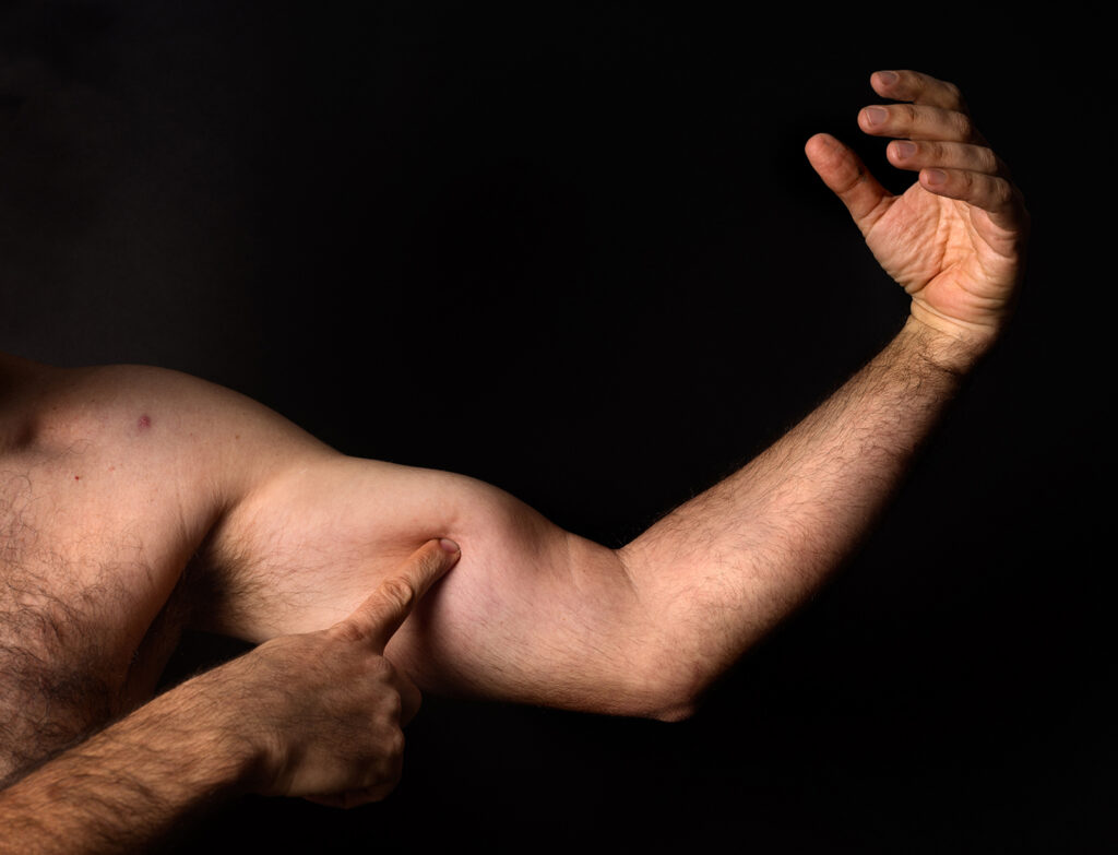 שריר - אייזנברג ציקי